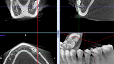 Exploración de impresiones CBCT